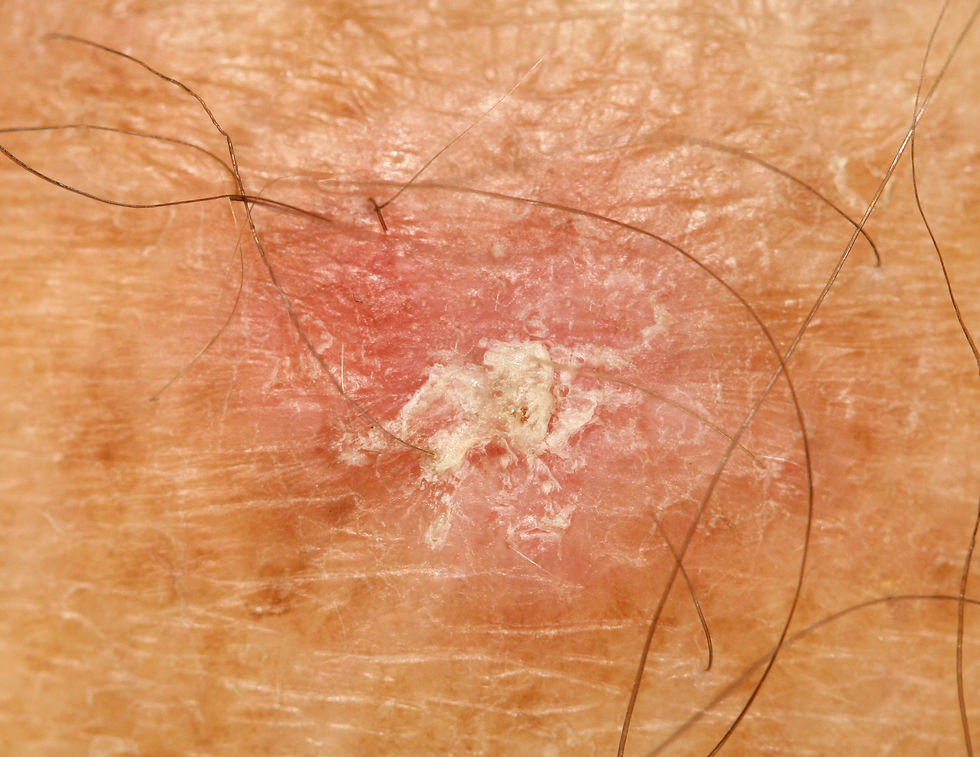 skin-growths-meridian-dermatology
